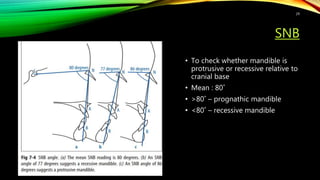 SNB
• To check whether mandible is
protrusive or recessive relative to
cranial base
• Mean : 80˚
• >80˚ – prognathic mandible
• <80˚ – recessive mandible
29
 