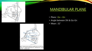 MANDIBULAR PLANE
• Plane : Go – Gn
• Angle between SN & Go-Gn
• Mean : 32˚
32
 