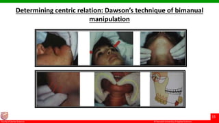© Ramaiah University of Applied Sciences
15
Faculty of Dental Sciences
Determining centric relation: Dawson’s technique of bimanual
manipulation
 