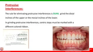 © Ramaiah University of Applied Sciences
34
Faculty of Dental Sciences
Protrusive
interferences:
The rule for eliminating protrusive interferences is DUML grind the distal
inclines of the upper or the mesial inclines of the lower.
In grinding protrusive interferences, centric stops must be marked with a
different colored ribbon.
 