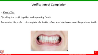 © Ramaiah University of Applied Sciences
37
Faculty of Dental Sciences
Verification of Completion
• Clench Test
Clenching the tooth together and squeezing firmly.
Reasons for discomfort :- Incomplete elimination of occlusal interferences on the posterior teeth
 