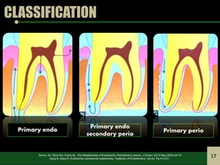 CLASSIFICATION
Primary perio
Primary endo
secondary perio
Simon JH, Glick DH, Frank AL. The Relationship of Endodontic–Per...