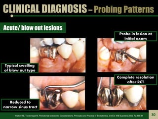 CLINICAL DIAGNOSIS– Probing Patterns
Acute/ blow out lesions
Typical swelling
of blow out type
Probe in lesion at
initial ...