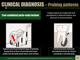CLINICAL DIAGNOSIS – Probing patterns
True combined perio-endo lesions
Independent periodontal and
periapical or lateral l...