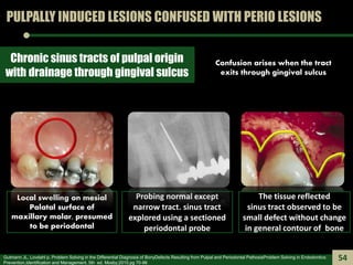 PULPALLY INDUCED LESIONS CONFUSED WITH PERIO LESIONS
Chronic sinus tracts of pulpal origin
with drainage through gingival ...