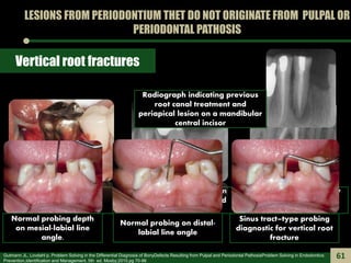 LESIONS FROM PERIODONTIUM THET DO NOT ORIGINATE FROM PULPAL OR
PERIODONTAL PATHOSIS
Vertical root fractures
Surgical expos...