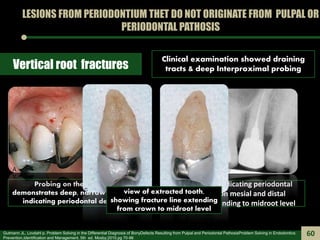 LESIONS FROM PERIODONTIUM THET DO NOT ORIGINATE FROM PULPAL OR
PERIODONTAL PATHOSIS
Vertical root fractures
Radiograph ind...