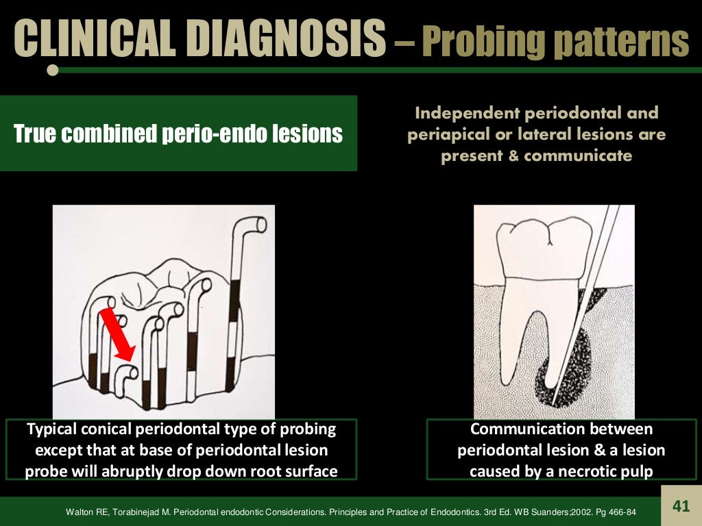 Endodontic Periodontal Relationship, ENDO PERIO LESION