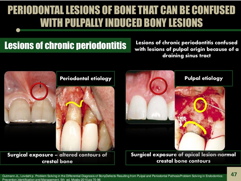 Endodontic Periodontal Relationship, ENDO PERIO LESION
