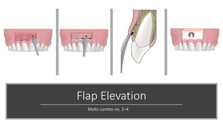 Flap Elevation
Molts curette no. 2–4
 