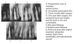 A, Preoperative view of
maxillary
central incisor.
B, Immediate postsurgical film
C, Three months after surgery,
D, One year after surgery, the
periapical bone has healed,
and the tooth is firm and
comfortable.
E, Nine years followup.
F, Nineteen years followup
G, Thirty-one years after original
treatment, still perfect
healing. Tooth is firm,
comfortable, and looks perfectly
normal!
 