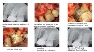 Lesion in relation to the mesiobuccal
root
Osteotomy and radisection of the
mesiobuccal root completed
Ultrasonic retropreparation
completed in both the canals
MTA retrofilling done
Immediate
postoperative radiograph
Three-month follow-up
radiograph showing healing
 
