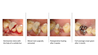 Hemisection done with
the help of a carbide bur
Mesial root surgically
extracted.
Postoperative healing
after 3 weeks
Full-coverage crown given
after 1 month.
 