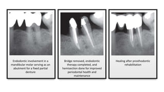 Endodontic involvement in a
mandibular molar serving as an
abutment for a fixed partial
denture
Bridge removed, endodontic
therapy completed, and
hemisection done for improved
periodontal health and
maintenance
Healing after prosthodontic
rehabilitation
 