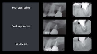 Pre-operative
Post-operative
Follow up
 