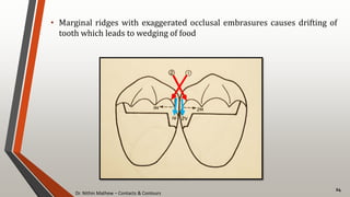 Dr. Nithin Mathew – Contacts & Contours
24
• Marginal ridges with exaggerated occlusal embrasures causes drifting of
tooth which leads to wedging of food
 