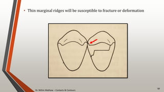 Dr. Nithin Mathew – Contacts & Contours
27
• Thin marginal ridges will be susceptible to fracture or deformation
 