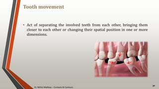Dr. Nithin Mathew – Contacts & Contours
Tooth movement
30
• Act of separating the involved teeth from each other, bringing them
closer to each other or changing their spatial position in one or more
dimensions.
 