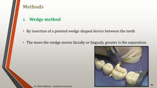 Dr. Nithin Mathew – Contacts & Contours
Methods
35
1. Wedge method
• By insertion of a pointed wedge shaped device between the teeth
• The more the wedge moves facially or lingualy, greater is the separation.
 