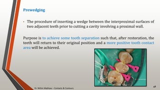 Dr. Nithin Mathew – Contacts & Contours
46
Prewedging
• The procedure of inserting a wedge between the interproximal surfaces of
two adjacent teeth prior to cutting a cavity involving a proximal wall.
Purpose is to achieve some tooth separation such that, after restoration, the
teeth will return to their original position and a more positive tooth contact
area will be achieved.
 