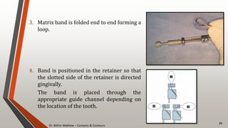 Dr. Nithin Mathew – Contacts & Contours
72
3. Matrix band is folded end to end forming a
loop.
4. Band is positioned in the retainer so that
the slotted side of the retainer is directed
gingivally.
The band is placed through the
appropriate guide channel depending on
the location of the tooth.
 