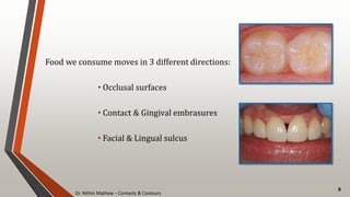 Dr. Nithin Mathew – Contacts & Contours
8
Food we consume moves in 3 different directions:
• Occlusal surfaces
• Contact & Gingival embrasures
• Facial & Lingual sulcus
 