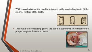 Dr. Nithin Mathew – Contacts & Contours
81
• With curved scissors, the band is festooned in the cervical region to fit the
gingival contour of the tooth.
• Then with the contouring pliers, the band is contoured to reproduce the
proper shape of the contact areas.
 
