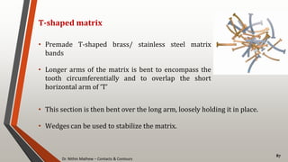 Dr. Nithin Mathew – Contacts & Contours
87
T-shaped matrix
• Premade T-shaped brass/ stainless steel matrix
bands
• Longer arms of the matrix is bent to encompass the
tooth circumferentially and to overlap the short
horizontal arm of ‘T’
• This section is then bent over the long arm, loosely holding it in place.
• Wedges can be used to stabilize the matrix.
 