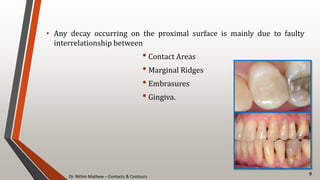 Dr. Nithin Mathew – Contacts & Contours
9
• Any decay occurring on the proximal surface is mainly due to faulty
interrelationship between
• Contact Areas
• Marginal Ridges
• Embrasures
• Gingiva.
 