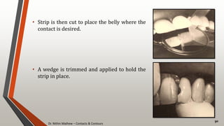 Dr. Nithin Mathew – Contacts & Contours
90
• Strip is then cut to place the belly where the
contact is desired.
• A wedge is trimmed and applied to hold the
strip in place.
 