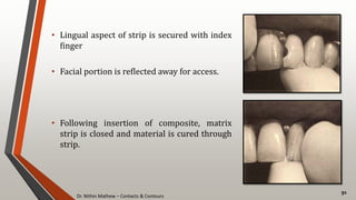 Dr. Nithin Mathew – Contacts & Contours
91
• Lingual aspect of strip is secured with index
finger
• Facial portion is reflected away for access.
• Following insertion of composite, matrix
strip is closed and material is cured through
strip.
 