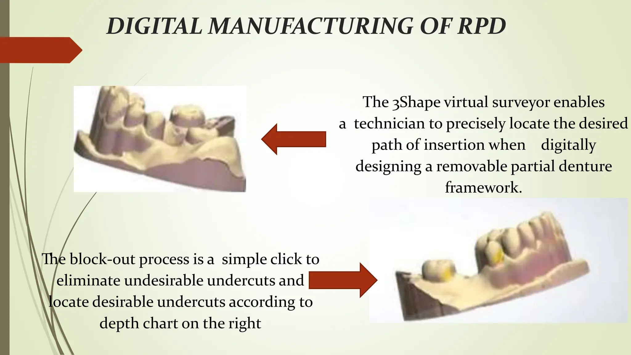 Lap Last Rpd Recent advances in rpd and it's uses in prosthodontics | PPTX