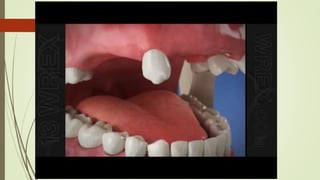 Tooth Lrpd Recent advances in rpd and it's uses in prosthodontics | PPTX