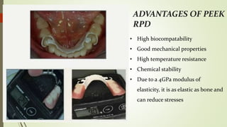 Rpd Vs Rpe Recent advances in rpd and it's uses in prosthodontics | PPTX
