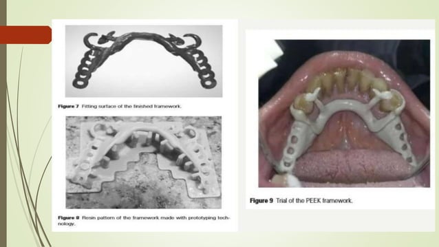 Tube Tooth Rpd Recent advances in rpd and it's uses in prosthodontics | PPTX