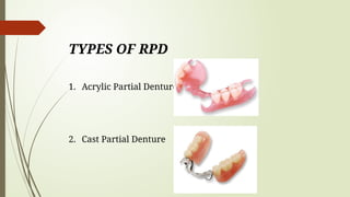 SEMINAR recent advances in Removable partial denture | PPTX