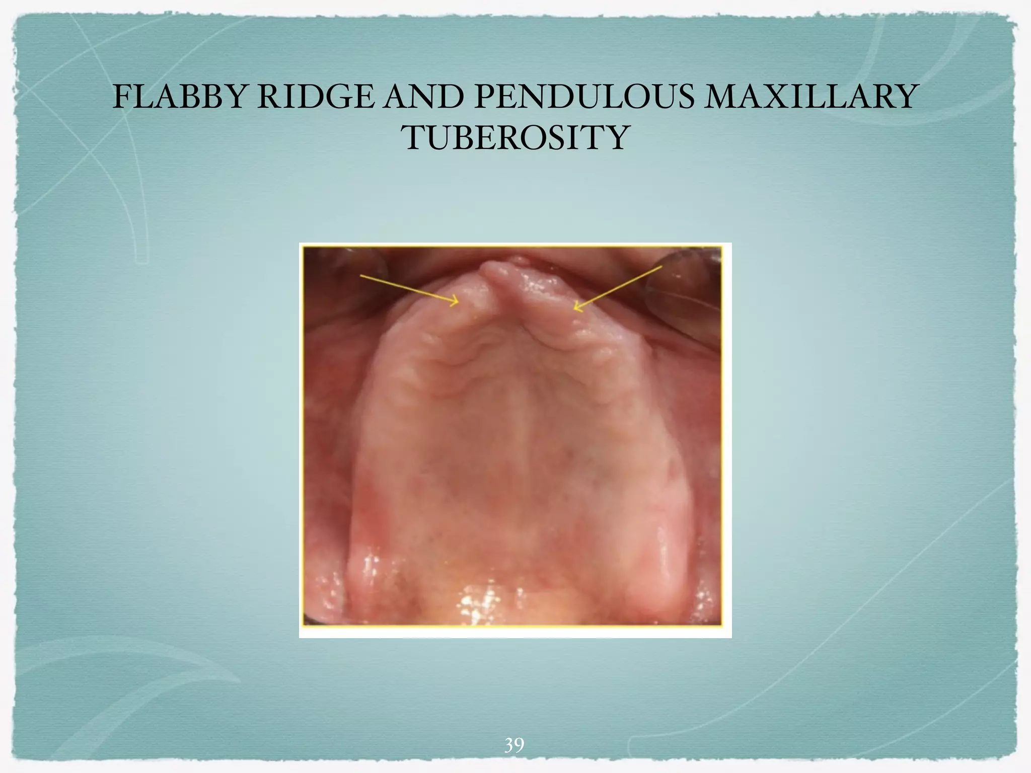 Flabby Ridge Radiograph Sequelae caused by wearing dentures | PDF
