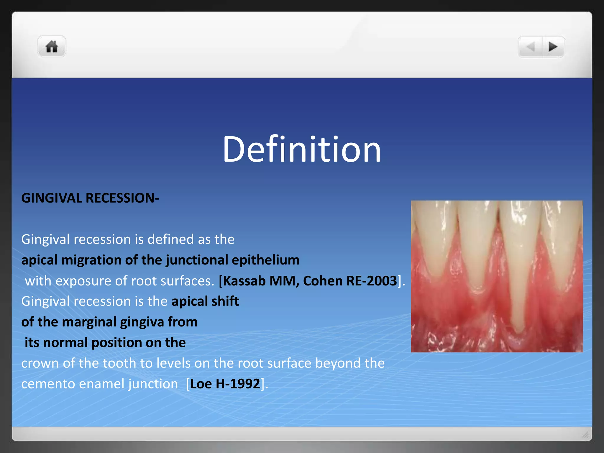 Definition
GINGIVAL RECESSION-
Gingival recession is defined as the
apical migration of the junctional epithelium
with exposure of root surfaces. [Kassab MM, Cohen RE-2003].
Gingival recession is the apical shift
of the marginal gingiva from
its normal position on the
crown of the tooth to levels on the root surface beyond the
cemento enamel junction [Loe H-1992].
 