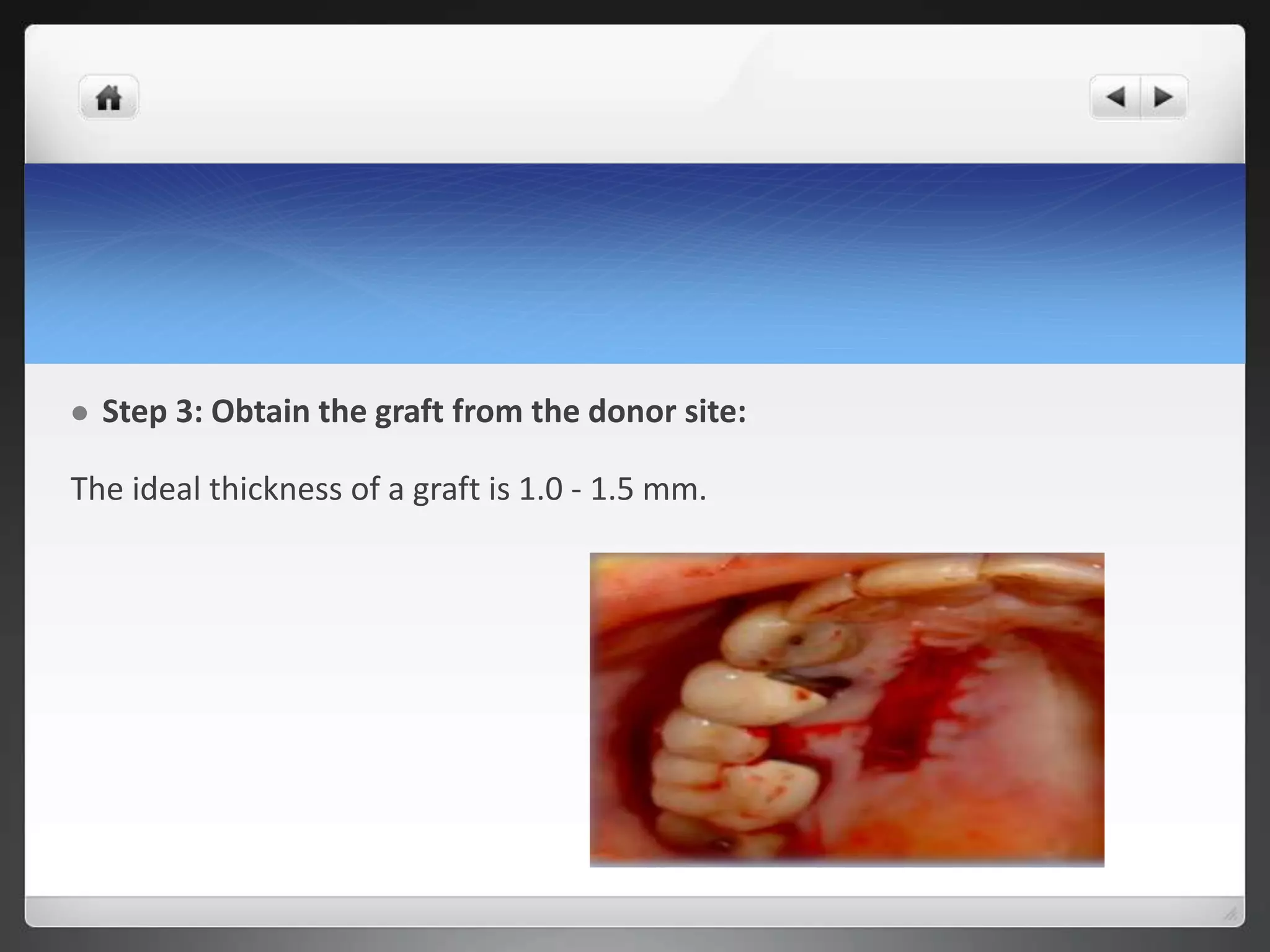  Step 3: Obtain the graft from the donor site:
The ideal thickness of a graft is 1.0 - 1.5 mm.
 
