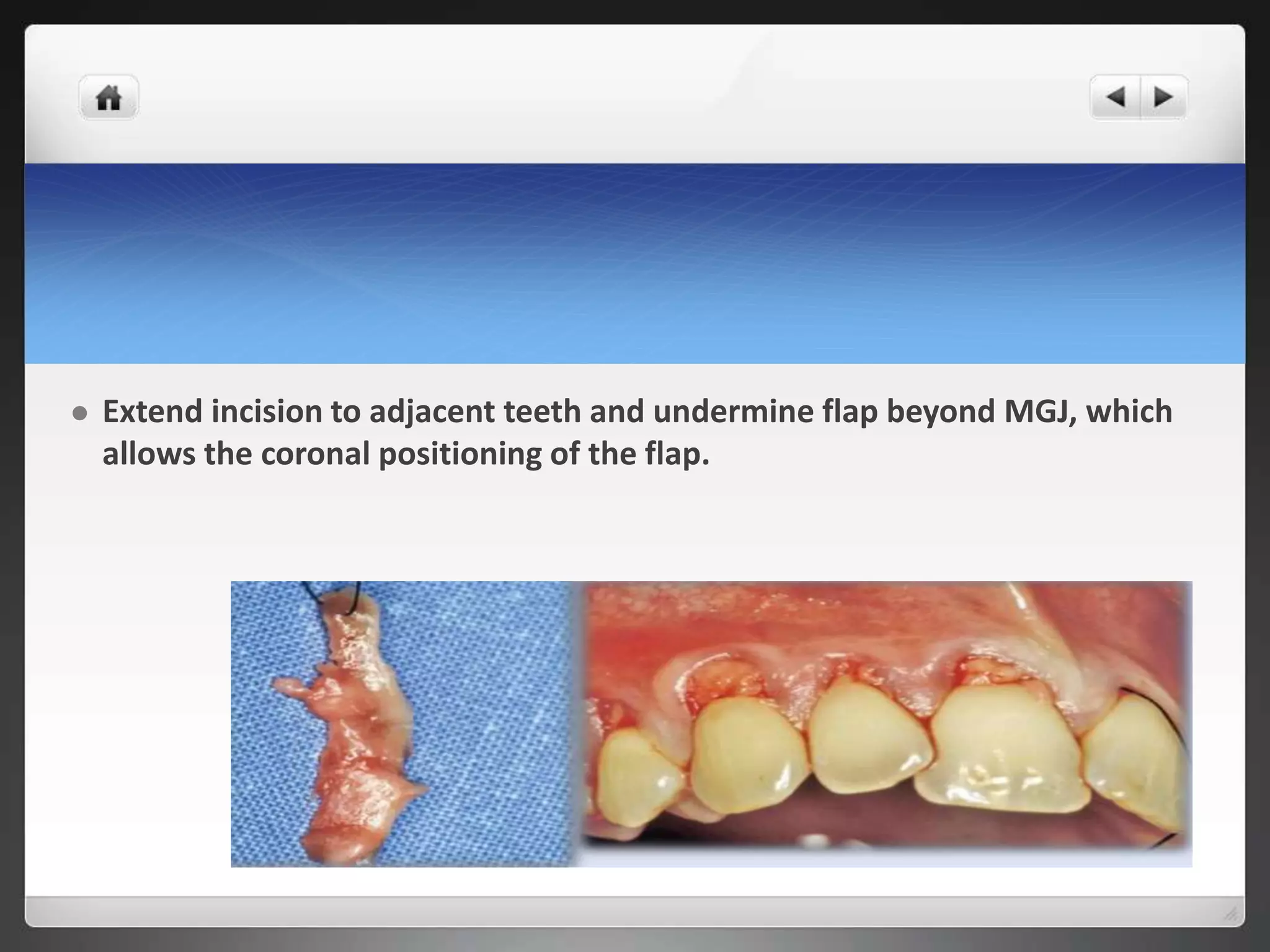  Extend incision to adjacent teeth and undermine flap beyond MGJ, which
allows the coronal positioning of the flap.
 