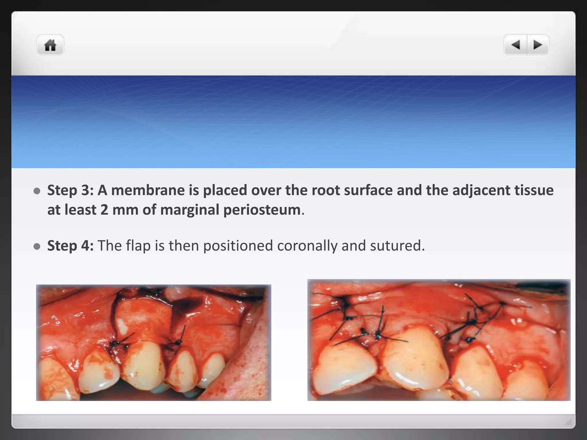  Step 3: A membrane is placed over the root surface and the adjacent tissue
at least 2 mm of marginal periosteum.
 Step 4: The flap is then positioned coronally and sutured.
 