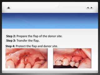 Step 2: Prepare the flap of the donor site.
Step 3: Transfer the flap.
Step 4: Protect the flap and donor site.
 