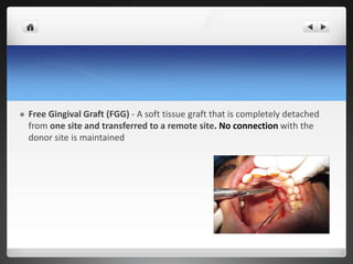  Free Gingival Graft (FGG) - A soft tissue graft that is completely detached
from one site and transferred to a remote site. No connection with the
donor site is maintained
 