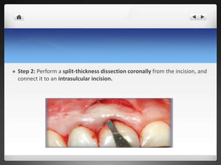  Step 2: Perform a split-thickness dissection coronally from the incision, and
connect it to an intrasulcular incision.
 