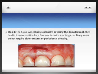  Step 3: The tissue will collapse coronally, covering the denuded root. then
held in its new position for a few minutes with a moist gauze. Many cases
do not require either sutures or periodontal dressing.
 
