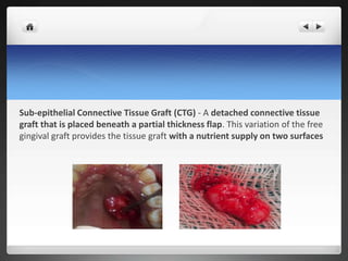Sub-epithelial Connective Tissue Graft (CTG) - A detached connective tissue
graft that is placed beneath a partial thickness flap. This variation of the free
gingival graft provides the tissue graft with a nutrient supply on two surfaces
 