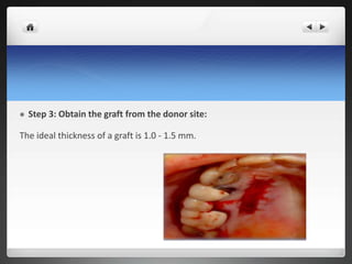  Step 3: Obtain the graft from the donor site:
The ideal thickness of a graft is 1.0 - 1.5 mm.
 