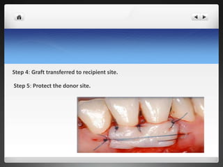 Step 4: Graft transferred to recipient site.
Step 5: Protect the donor site.
 