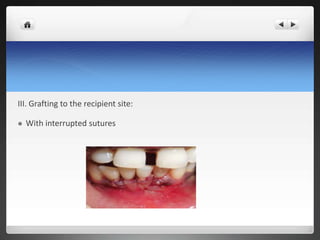 III. Grafting to the recipient site:
 With interrupted sutures
 