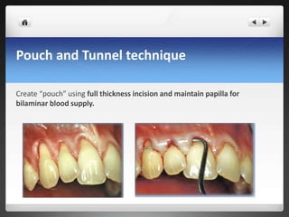 Pouch and Tunnel technique
Create “pouch” using full thickness incision and maintain papilla for
bilaminar blood supply.
 